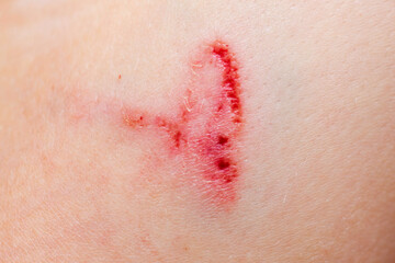 A wound on the human body, deep cut, scar closeup. Deep scratches on the skin with bruises