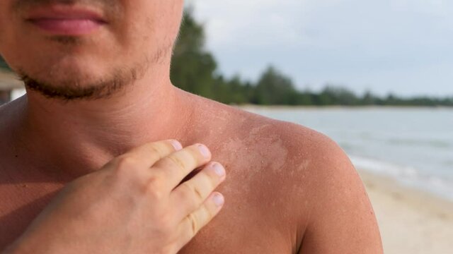Unrecognized man touch heat skin burn on shoulder on sea coast background. Recreational activity of sun bathing.