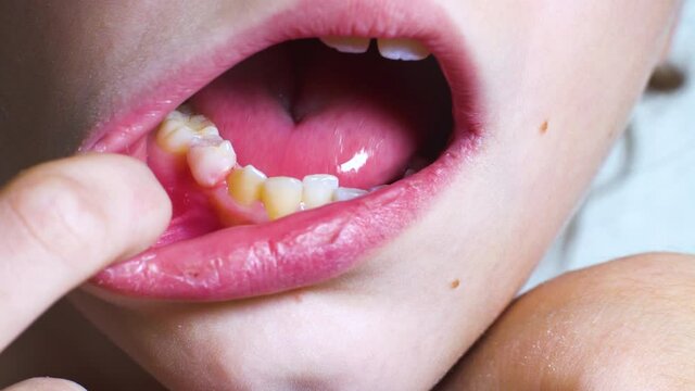 Pre-teen child opening mouth wide with finger and trying to remove wobbly baby tooth with tongue. Macro of dental cavity during changing milk teeth to molar teeth. Concept of oral health care