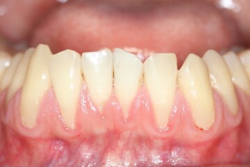 Gingival recession, also known as receding gums, is the exposure in the roots of the teeth caused...