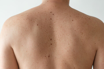 Naklejka premium Checking benign moles. Close up detail of the bare skin on a man back with scattered moles and freckles
