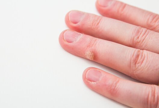 Close up view of skin disease called wart caused by human papilloma virus on human finger.