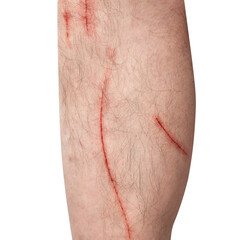 Scratch on a man's leg. Fresh wounds from cat claws. Human shin is damaged. Isolated on white