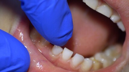 Dentist Inspecting Loose Tooth in Blue Gloves