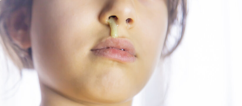 Snot in a child face close-up. Cold. Selective focus.