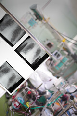 X-ray images on the background of patinet in the ICU