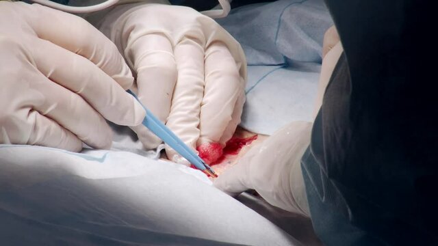 surgeon is cauterizing wounds during operation in medical clinic, close-up view of hands and tools, saving life