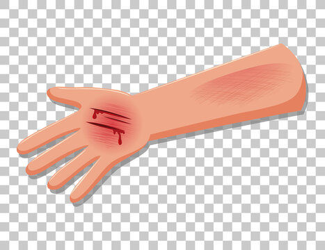 injured arm with cuts and blood clip art preview