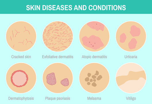 Vector illustration "Skin diseases and conditions". 8 circle images set. Skin with different disorders. Colorful infographic for medical articles, posters and banners.