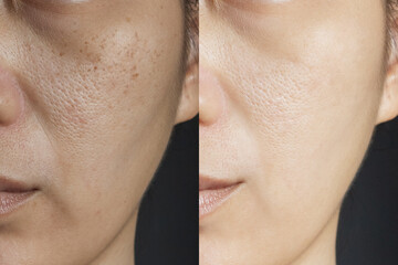 two pictures compare effect Before and After treatment. skin with problems of freckles , pore ,...