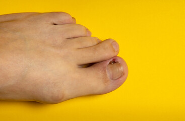 Ingrown nail or purulent onychocryptosis. Leg with wound on a yellow background