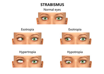 Strabismus, eyes deviation, illustration