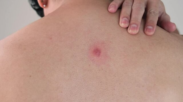 The back of a young Asian man with red abscesses or pimples.