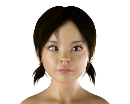 Strabismus, eyes deviation, illustration