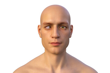 Strabismus, eyes deviation, illustration