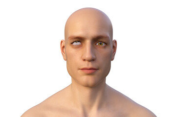 Strabismus, eyes deviation, illustration