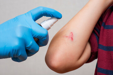 Doctors hand sprays an antiseptic agent on the wound on the childs hand. Treatment the wound. First...