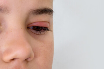 Child's eye stye. Ophthalmic infectious disease hordeolum