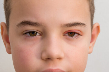 Child's eye stye. Ophthalmic disease hordeolum. Inflammatory process in the eyes