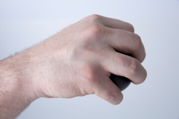 Missing Knuckle From Boxer's Fracture on Right Ring Finger