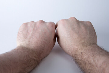 Missing Knuckle From Boxer's Fracture on Right Ring Finger