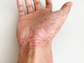 Fototapeta premium Hand peeling