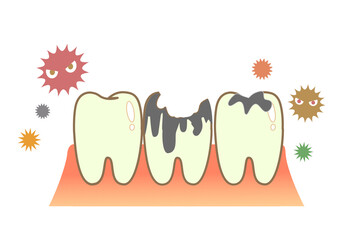 illustrations of dental sealants treatment before after