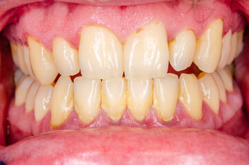 close up of teeth with gingivitis and dental plaque