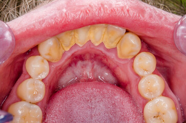 tartar and ginigvitis , lower incisors