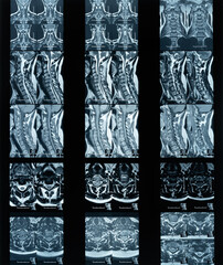 Magnetic resonance imaging neck disc protrusion