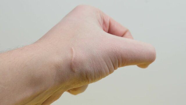 scar close-up arm, glass cut, macro. selective focus. human skin