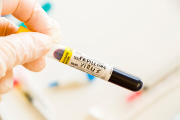 Papilloma virus blood test tube sample on the white background in the laboratory