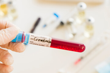 Creatinine blood test tube sample in doctors hand in laboratory