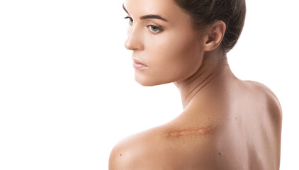 Young woman with a scar on her shoulder