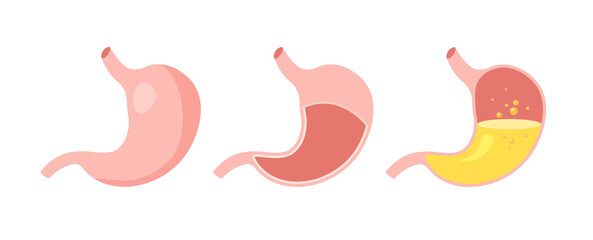 Healthy and unhealthy, empty and full human stomach in trendy flat style. Nutrition, stomach pain, bloating. Digestive system anatomy. Vector illustration isolated on white background.