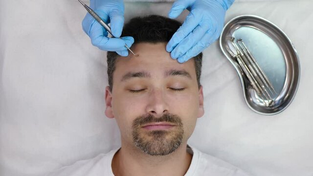Beautician uses cosmetic spoon on bearded handsome middle aged man, top view. Anti acne therapy concept. Treatment of inflammation for an attractive male face