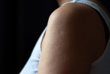 closeup of a young woman vaccine scar on the left upper arm