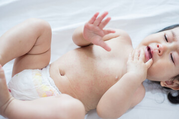 baby rash skin, prickly heat on baby (selective focus)