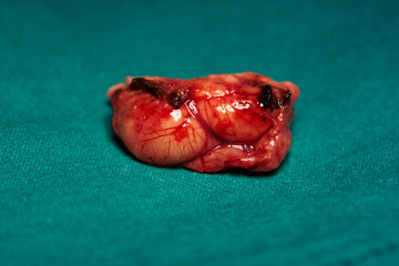 Specimen of brain tumor after surgical excision