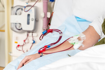 arm of a patient with a hemodialysis catheter during a treatment