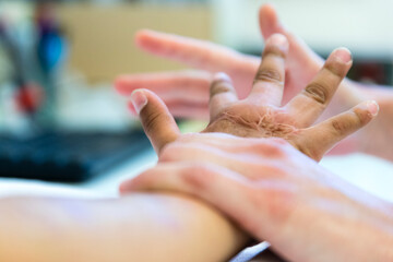 an occupational therapist works the hand of a burnt child