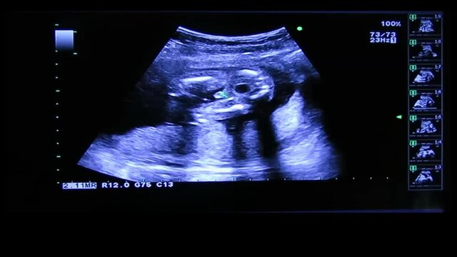 Sex of human embryo on an ultrasound display, Monitor showing the male baby
