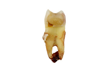 Removed human tooth, premolar, with granuloma at the roots, a piece of alveolar bone near the neck of the tooth and a filling on the proximal surface.