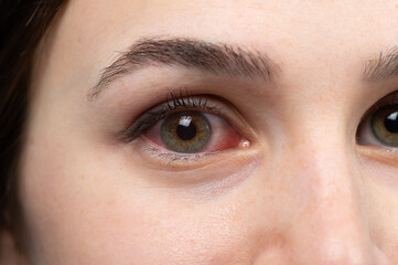 Macro of a girl's red eye, allergy triggered conjunctivitis concept