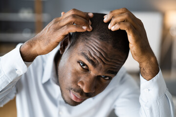 Young African Men Hair Loss - obrazy, fototapety, plakaty
