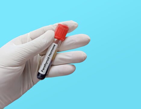Biochemist or Doctor holds Blood sample for Parathyroid Hormone (PTH) test. Diagnosis for organ disease. Medical testing concept.