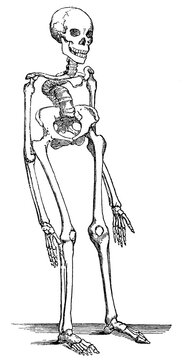 Human skeleton with rickets. Illustration of the 19th century. Germany. White background.