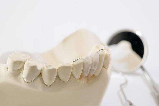 Closeup / Dental maryland bridge / Crown and bridge equipment and model express fix restoration.