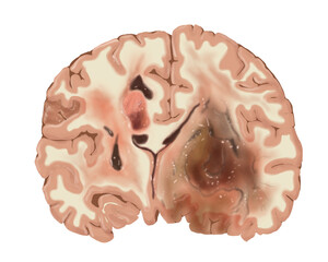Brain tumor cross-section illustration