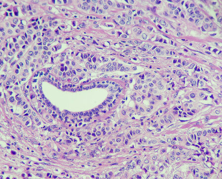 Photo of breast carcinoma compare with benign mammary duct, magnification 400x, photo under microscope